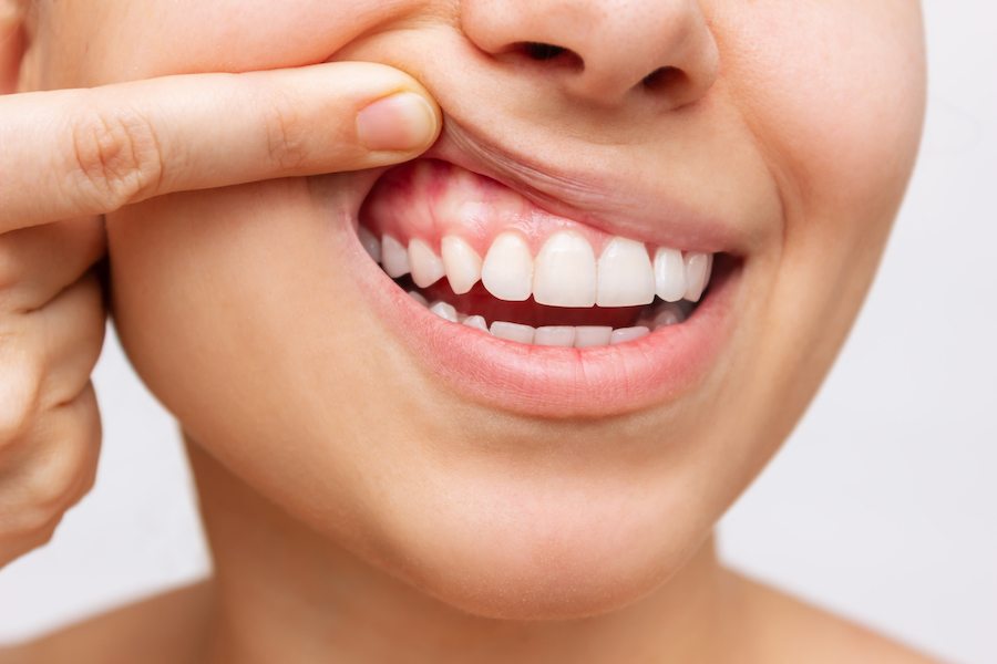 Closeup of a woman pulling up her upper lip to show her gums