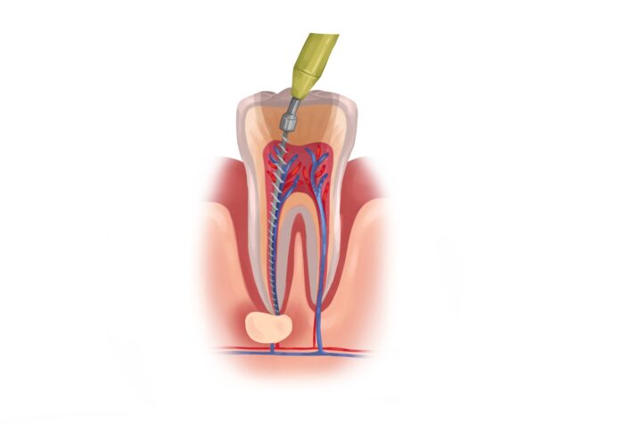 root canal therapy, root canal, root canals
